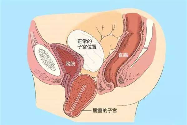 【產(chǎn)后修復(fù)】盆腔臟器脫垂，你有嗎？