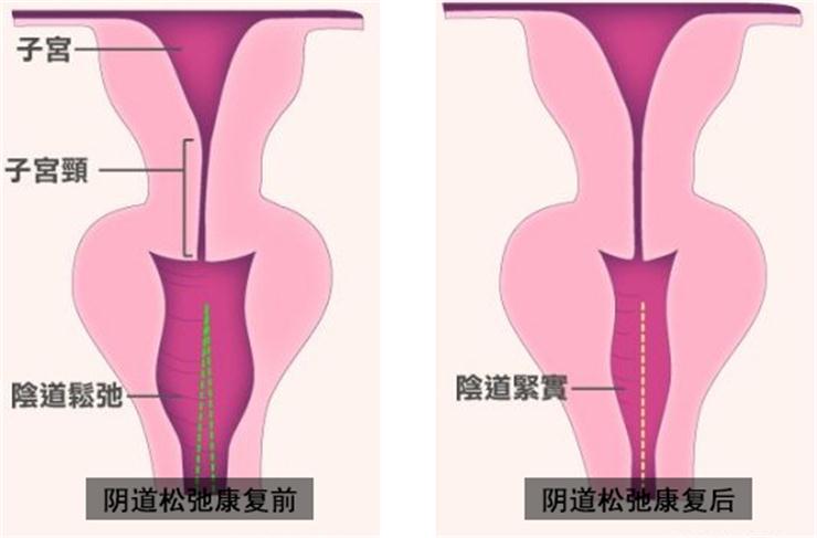 【盆底肌修復(fù)】盆底不修復(fù)，老來后患無窮