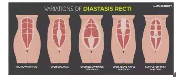 腹直肌分離如何分類？腹直肌分離修復(fù)