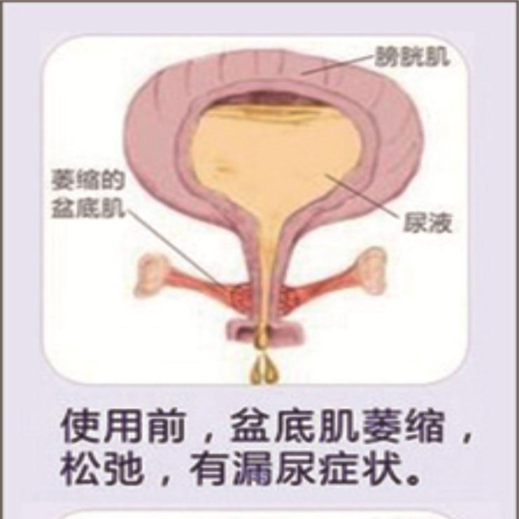 產(chǎn)后盆底肌康復|“社交癌”盯上你了嗎？