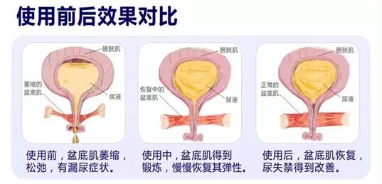 盆底康復(fù)治療怎么做？產(chǎn)后盆底功能檢測(cè)很重要