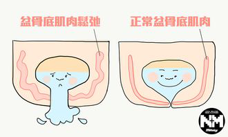 盆底肌損傷后沒有癥狀可以不治療嗎