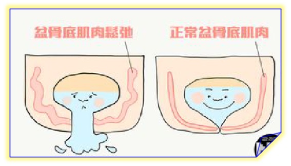 盆底康復(fù)治療怎么做，盆底肌修復(fù)常見的十大問題（中）