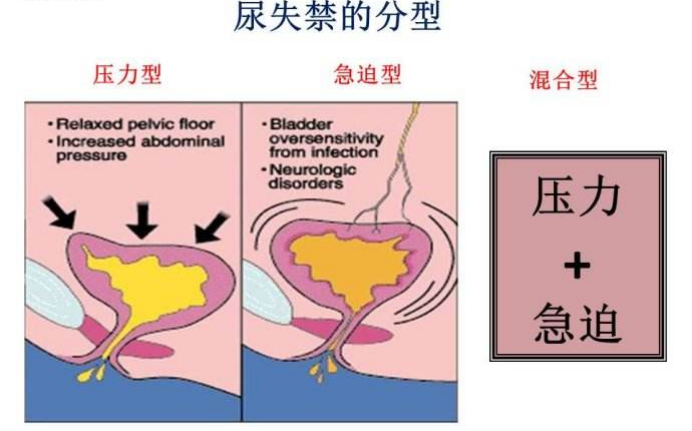 產(chǎn)后盆底肌怎么修復(fù)|尿失禁的類型，傻傻分不清