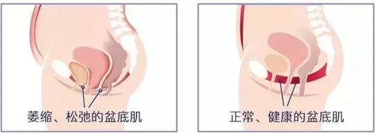 尿失禁治療儀器，不再詢問盆底康復(fù)治療有用嗎這類無意義問題