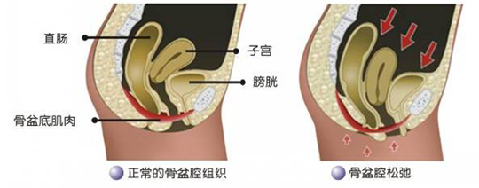 盆底功能檢測很重要，盆底肌松弛了會有什么表現(xiàn)呢？