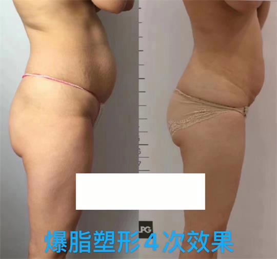 產(chǎn)后塑形美雕儀，生完孩子真的很難恢復(fù)身材？未必……