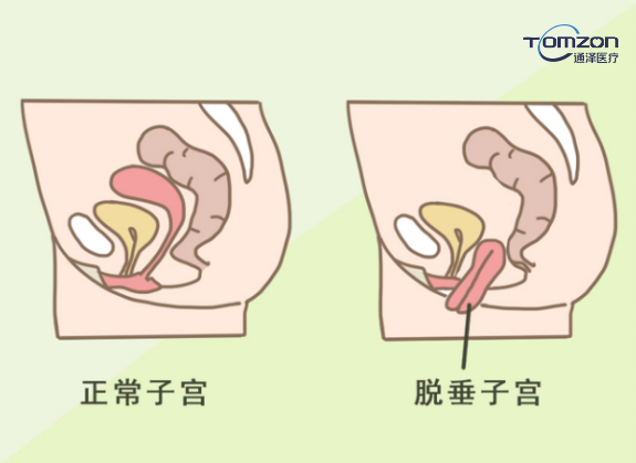 你害怕子宮脫垂嗎？盆底肌修復(fù)儀器來拯救你