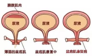 尿頻尿急尿不盡？或者可以試試盆底肌修復(fù)儀器電刺激