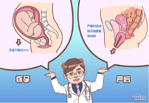 盆底康復治療儀可以解決子宮下降問題嗎？