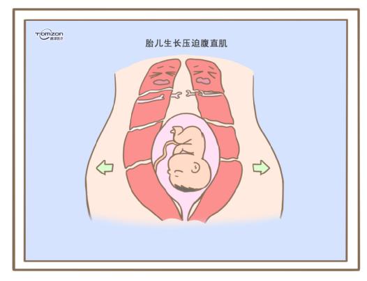 腹直肌分離可以使用盆底肌修復(fù)儀器嗎？