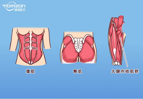 凱格爾運(yùn)動該怎么做？盆底肌修復(fù)儀器還能用嗎？