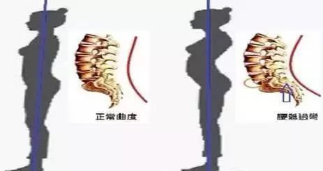 腹直肌分離