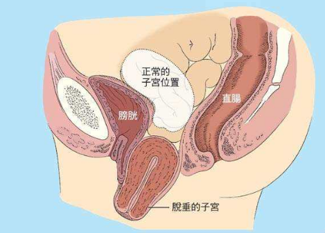 盆底修復(fù)治療