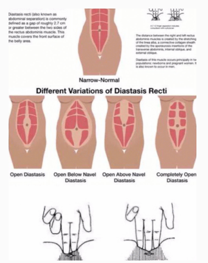 產后腹直肌分離