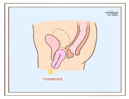 盆底肌修復(fù)儀器.jpg